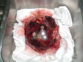 Tumor.jpg