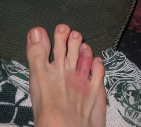 broken%20toe.JPG