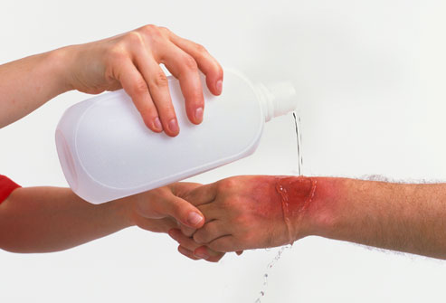 493x335px-LL-ee7e2365_minor-burn-treatment.jpeg