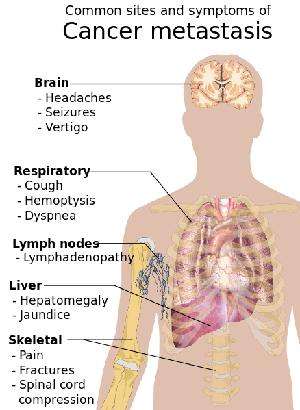 438px-Symptoms_of_cancer_metastasis.svg.png