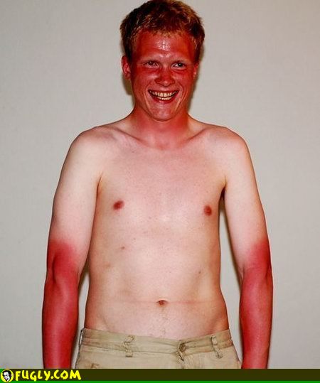 sunburn.jpg