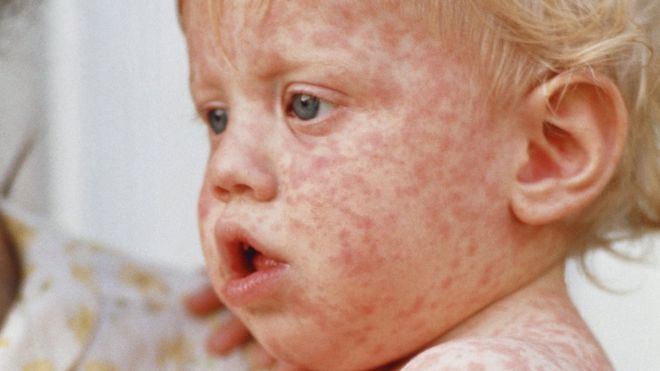 _107174554_measles.jpg